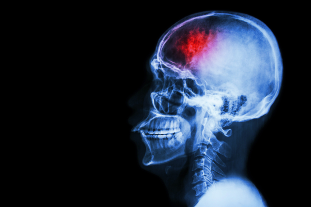 X-ray scan showing a traumatic brain injury highlighted in red